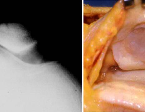 Artrosi articolazione femoro-rotulea conseguenza di un ginocchio valgo severo 1