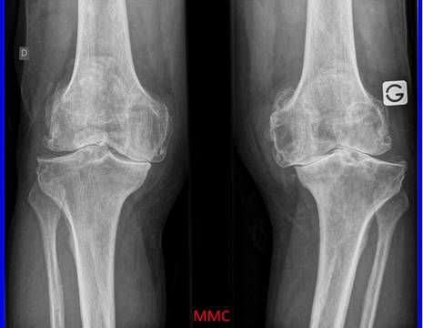 Artrosi grave di ginocchio per cui non sono indicate infiltrazioni con acido ialuronico 1