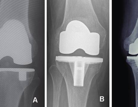 A protesi non cementata a conservazione dei crociati. B protesi postero-stabilizzata. C protesi semivincolata per insufficienza legamento collaterale 1