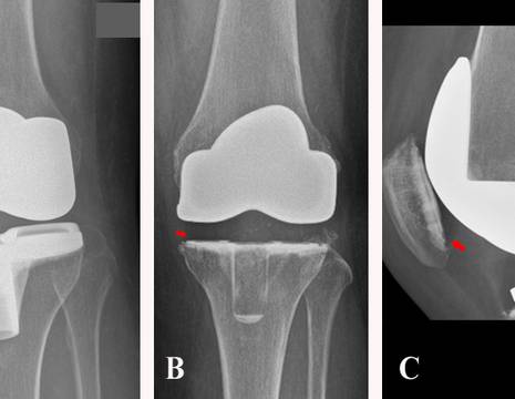 Diversi tipi di protesi TOTALE. A protesi cementata su femore e tibia. B protesi all-poly tibiale. C protesi ibrida, cementata solo su tibia e rotula 1