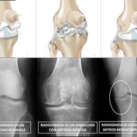 Artrosi ed artrite al ginocchio