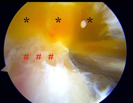 Immagine in artroscopia. Fuoriuscita di materiale mucinoso (*) dal legamento crociato anteriore degenerato (#) 1