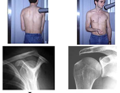 Proiezioni radiografiche di spalla secondo Grashey (cosiddetta AP vera) e Lamy 1