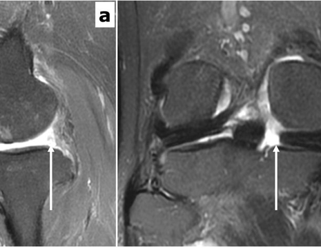Aspetto RMN di lesione radice meniscale. ​a). Assenza di segnale del menisco (ghost sign). b) Lesione radiale lineare del menisco interno 1