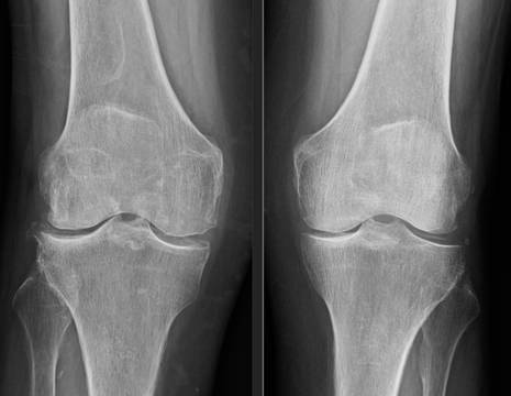 Rx dello stesso paziente con segni di ARTROSI (sinistra) ed ARTRITE (destra) di ginocchio 1