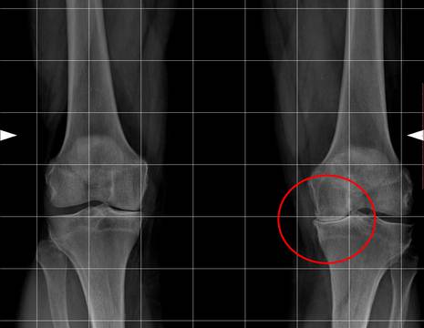 Rx prima dell'intervento, si nota l'artrosi del solo comparto interno del ginocchio 1