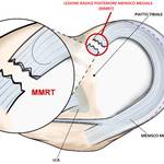 LESIONI RADICI DEL MENISCO. COSA SONO E COME TRATTARLE