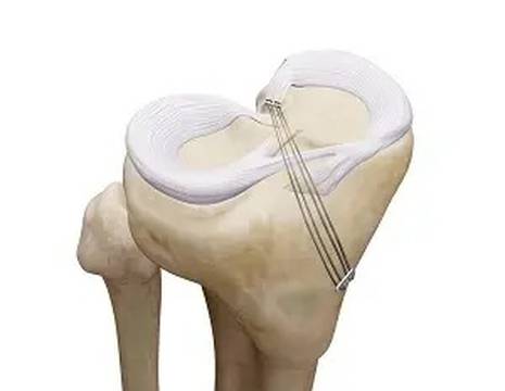 Schema riparazione lesione radice (root) con fili fissati alla tibia 1