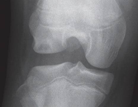 radiografia tipica di menisco discoide 1