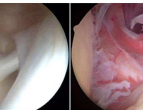 Spalla con articolazione nella norma (a sinistra) e spalla con infiammazione articolare tipica della capsulite adesiva (a destra) 1