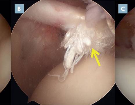 Visione artroscopica capo lungo del bicipite normale (A); lesione parziale con sfilacciamento del tendine (B); lesione completa del tendine (C) 1