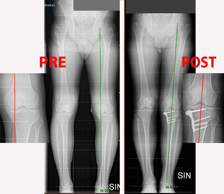 C:\fakepath\Osteotomia tibiale valgizzante pre e post intervento.jpg