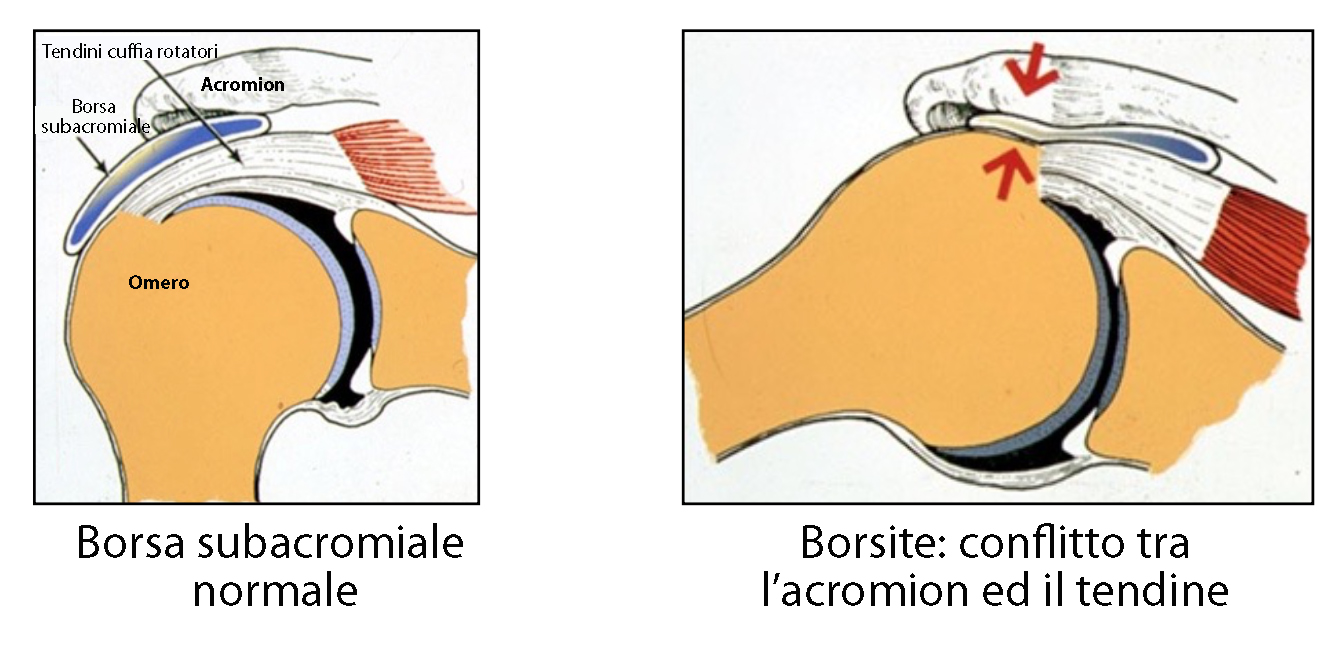 Schema conflitto subacromiale di spalla