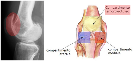 Compartimenti dell'articolazione del ginocchio. Il comparto anteriore corrisponde all'articolazione femoro.rotulea.jpg