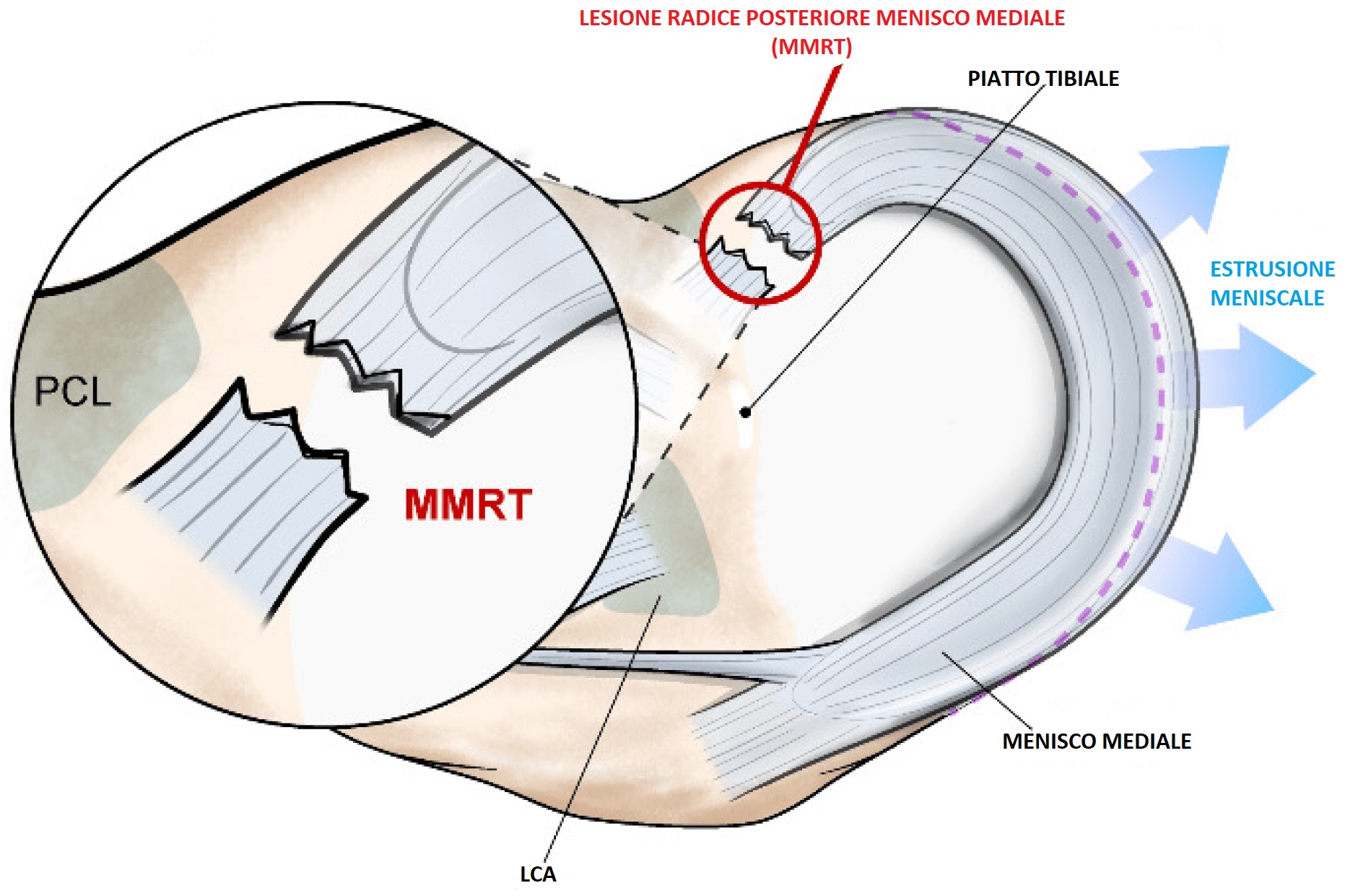 Lesione radice menisco (root)