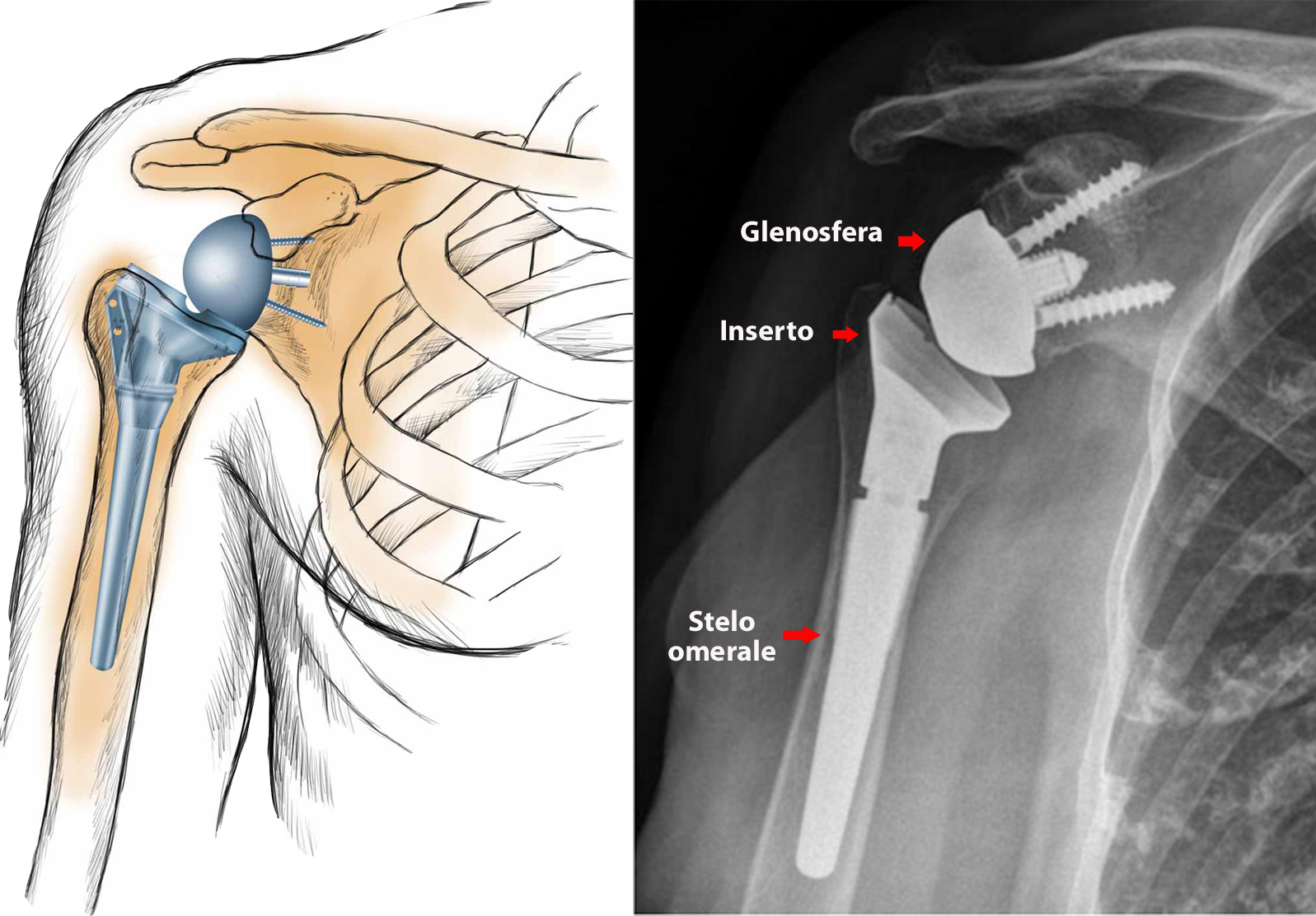 Protesi inversa di spalla